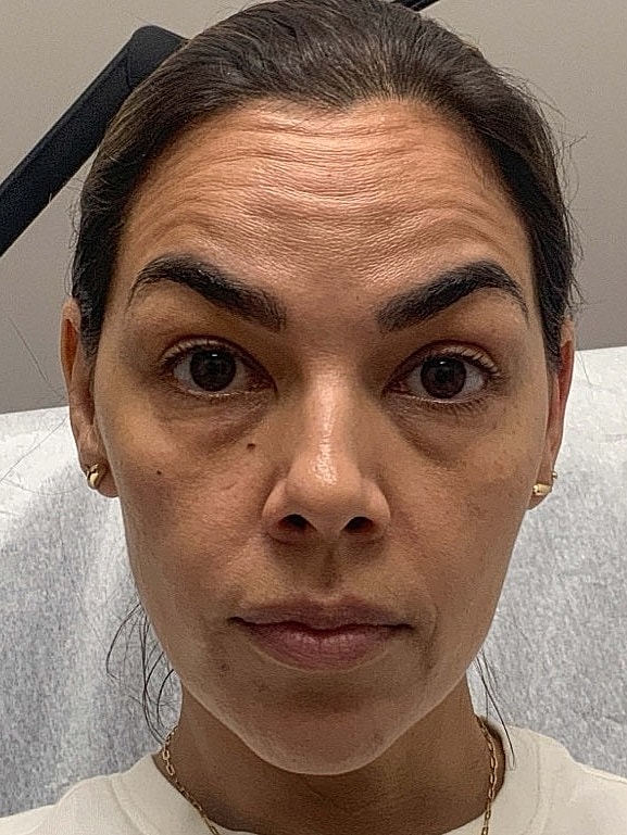 Botox Before & After