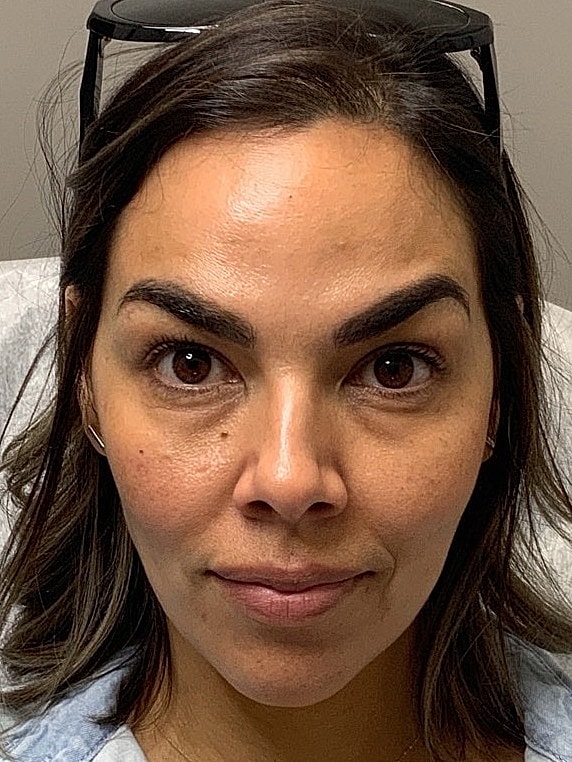 Botox Before & After