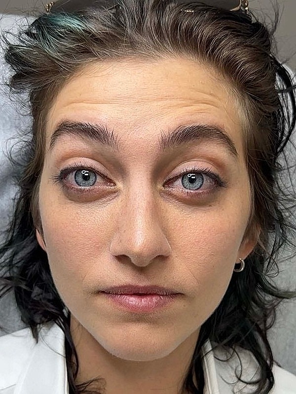 Botox Before & After