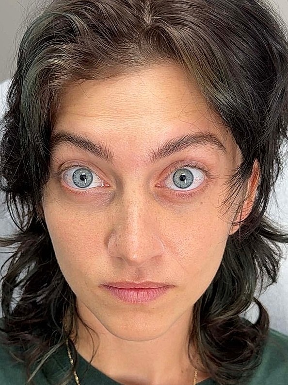 Botox Before & After
