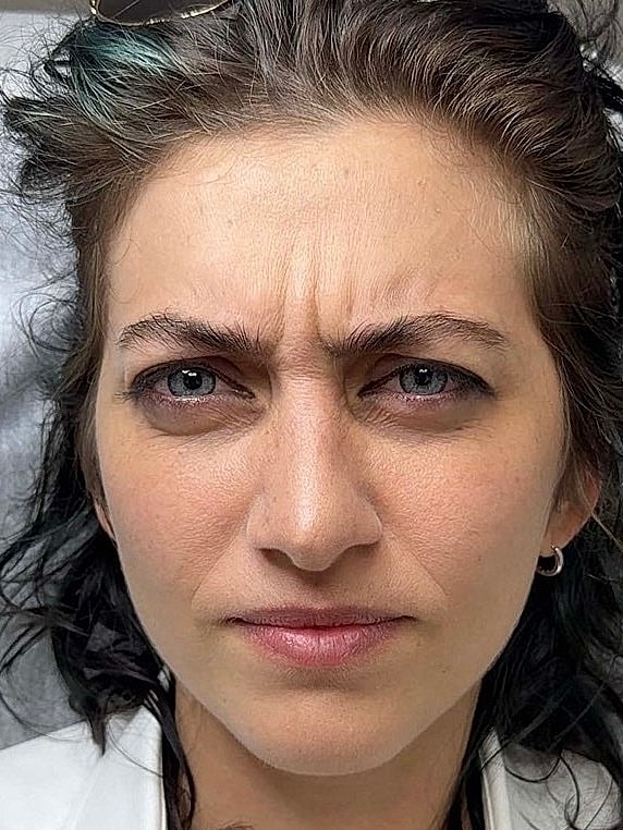 Botox Before & After