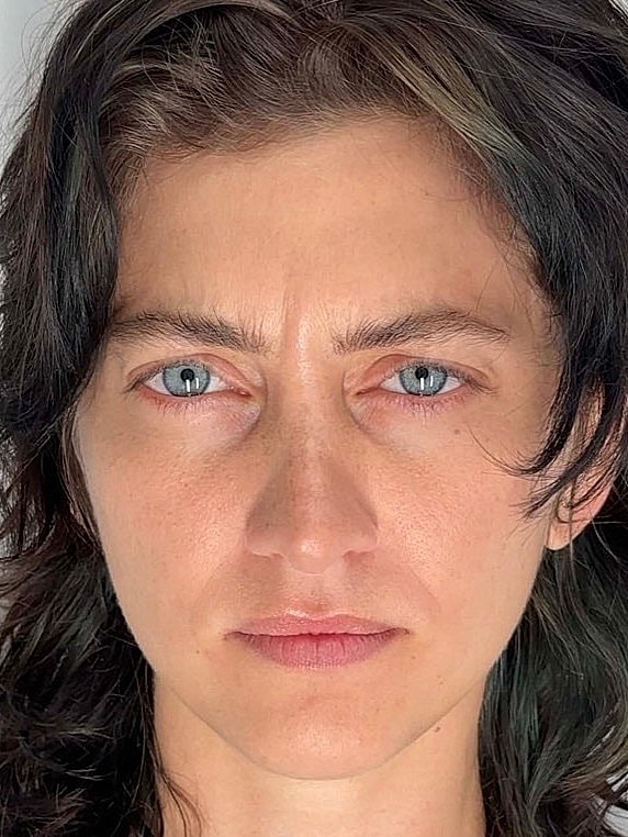 Botox Before & After
