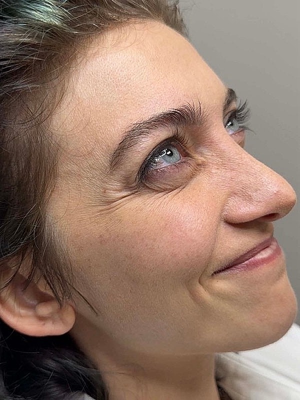 Botox Before & After