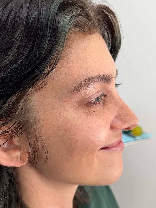 Botox Before & After