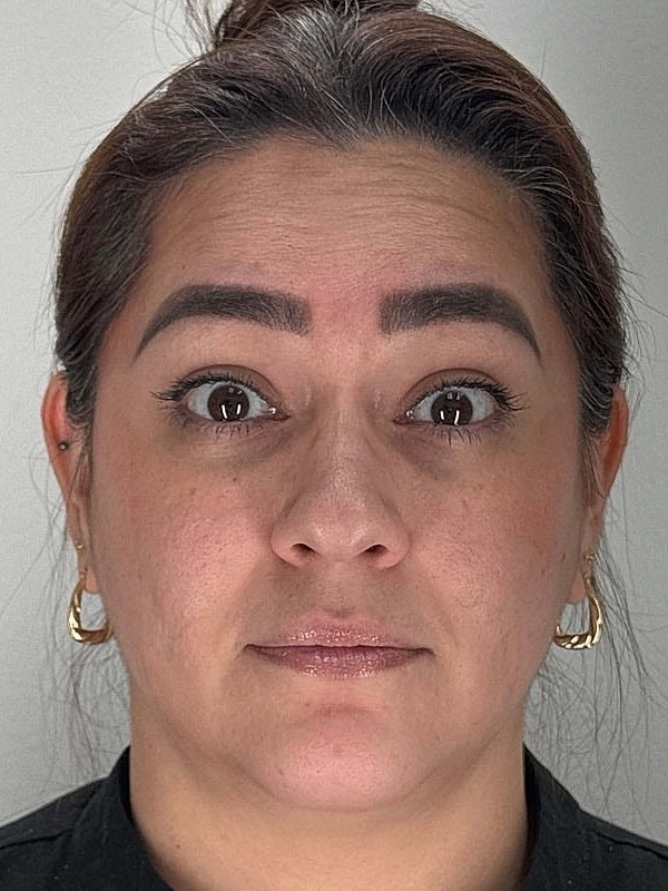 Botox Before & After
