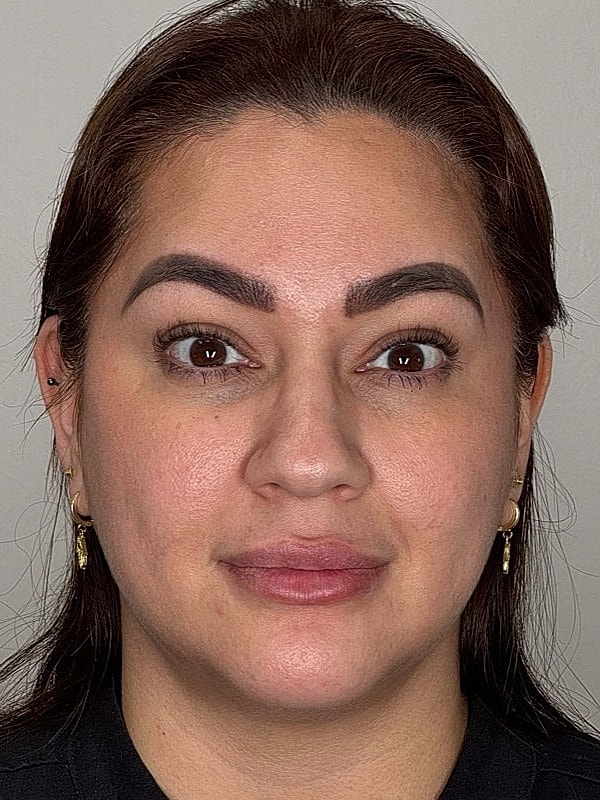 Botox Before & After