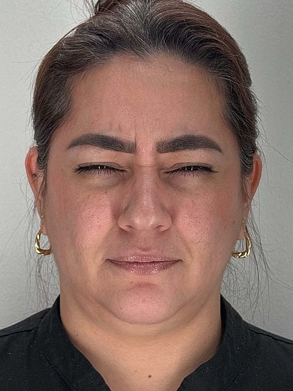 Botox Before & After