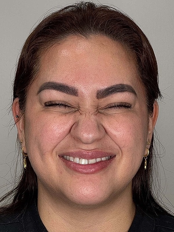 Botox Before & After