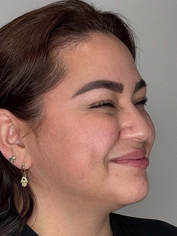 Botox Before & After