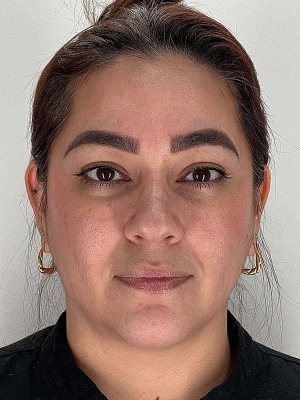 Botox Before & After