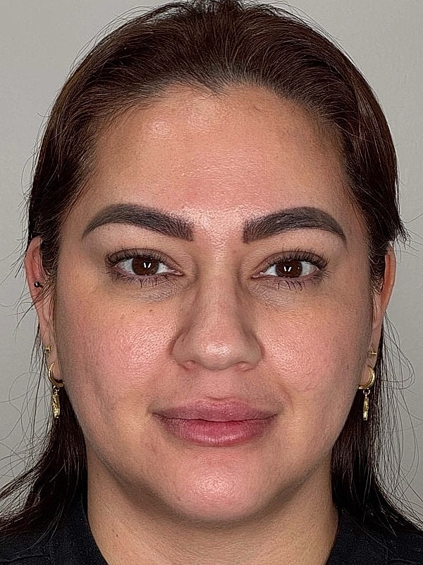 Botox Before & After
