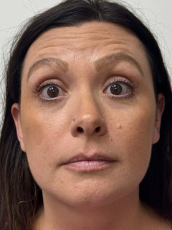 Botox Before & After