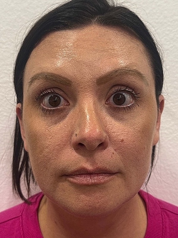 Botox Before & After