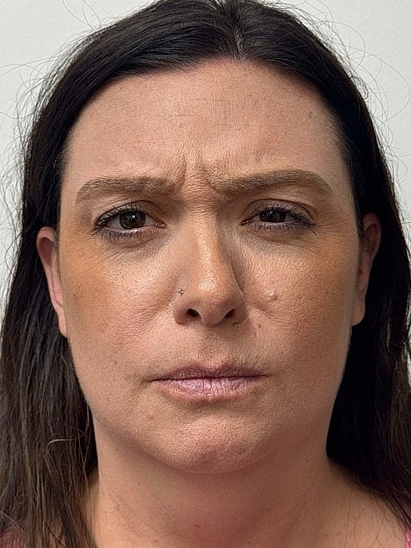 Botox Before & After