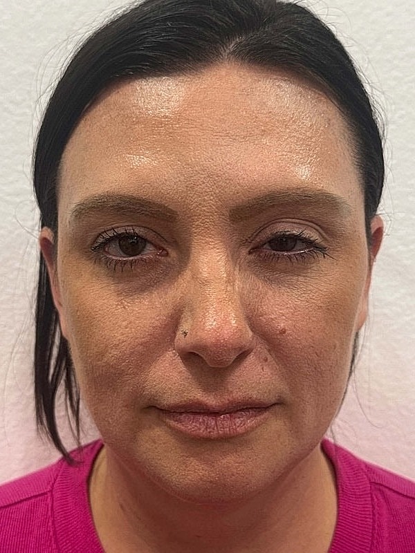 Botox Before & After