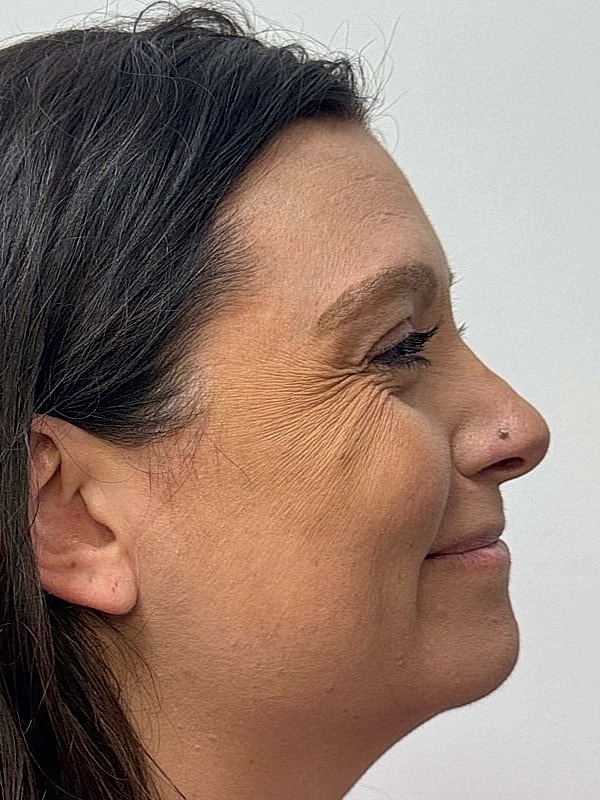 Botox Before & After