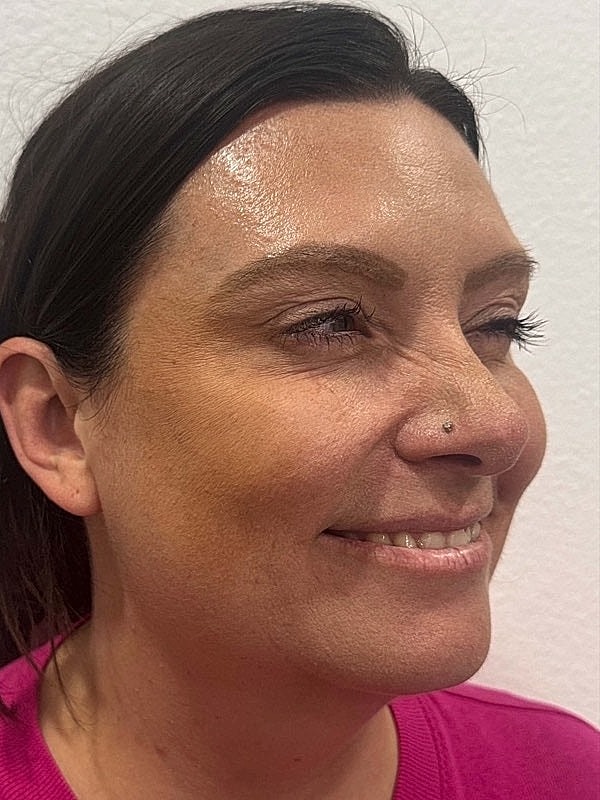 Botox Before & After