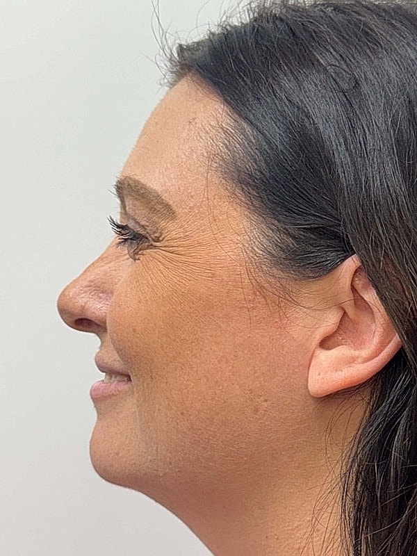 Botox Before & After
