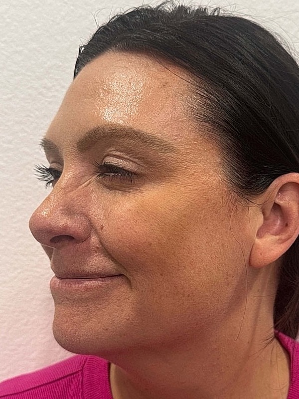 Botox Before & After