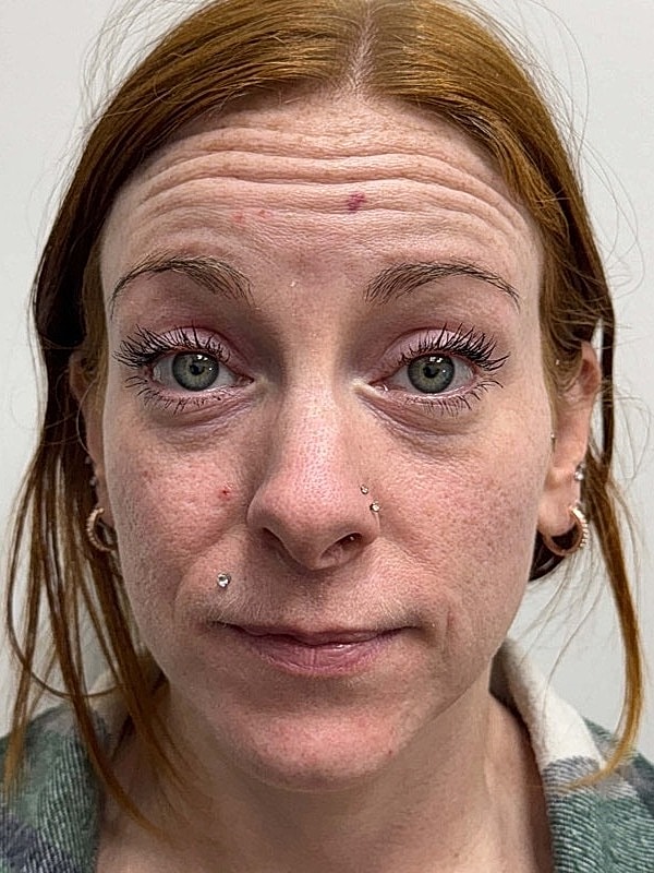 Botox Before & After