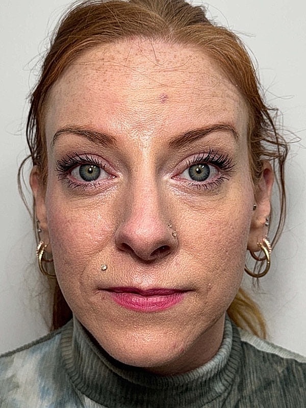 Botox Before & After