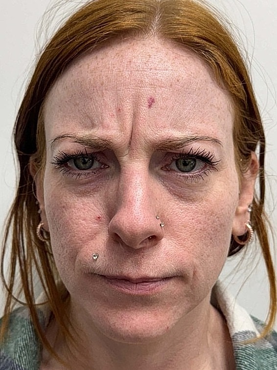 Botox Before & After