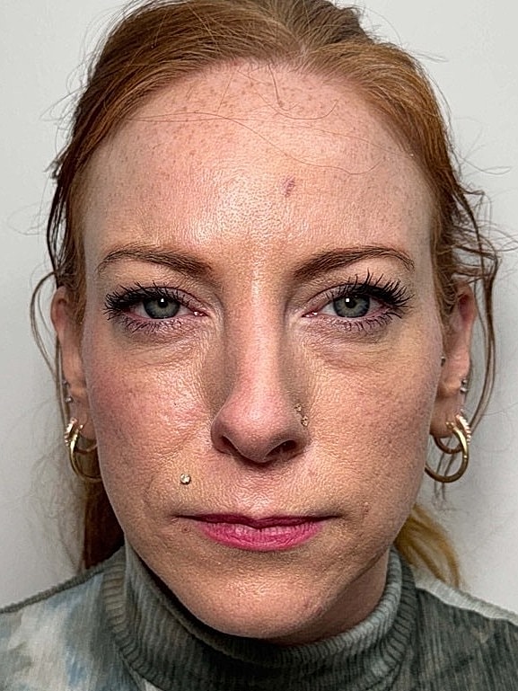 Botox Before & After