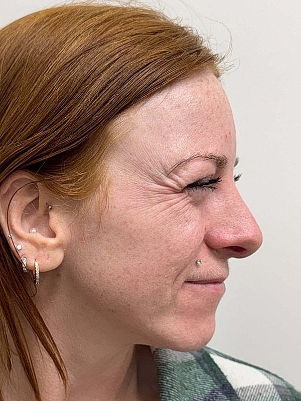 Botox Before & After