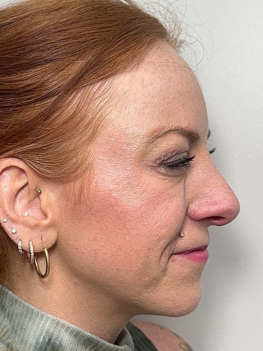 Botox Before & After