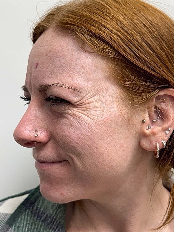 Botox Before & After