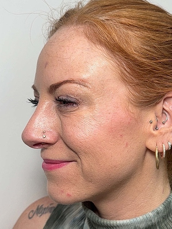 Botox Before & After