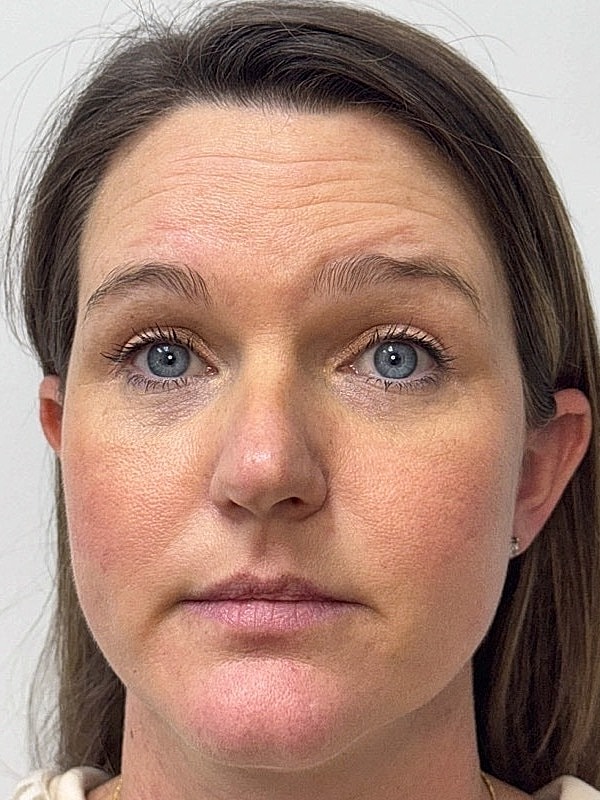 Botox Before & After