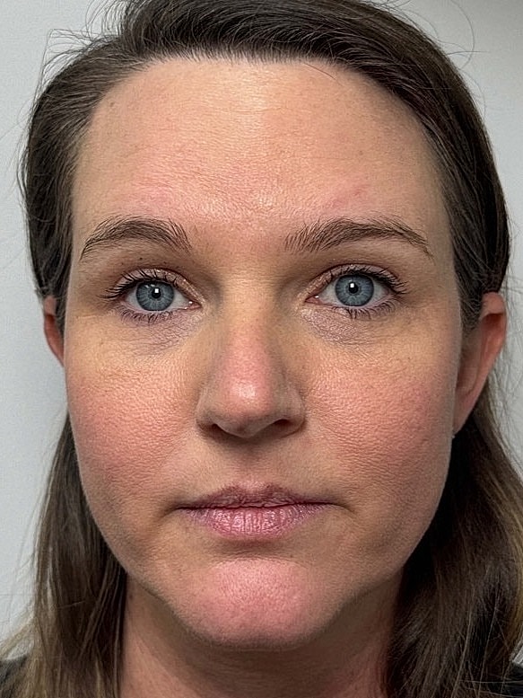 Botox Before & After