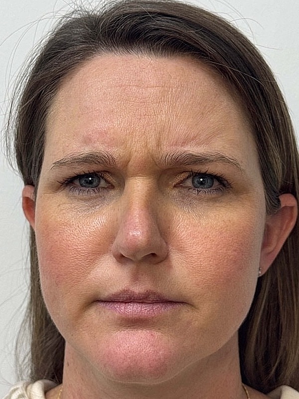 Botox Before & After