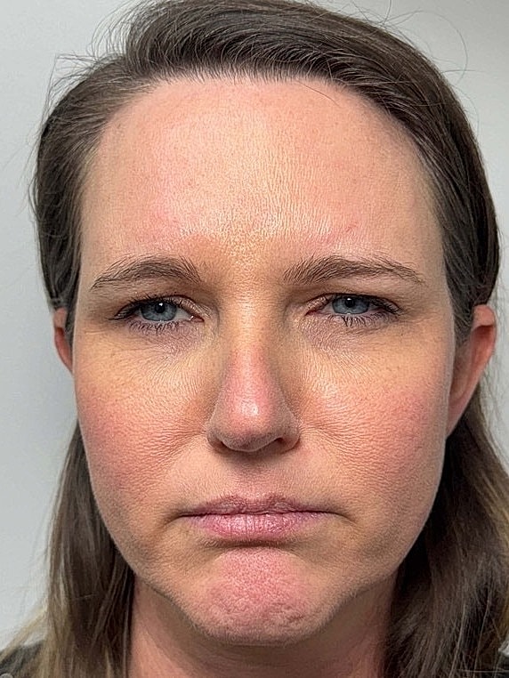 Botox Before & After