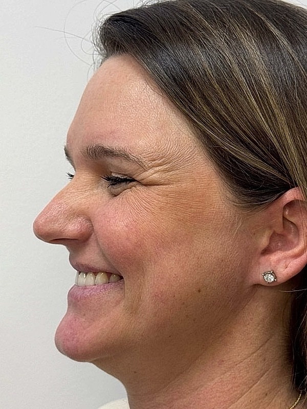 Botox Before & After