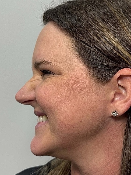 Botox Before & After