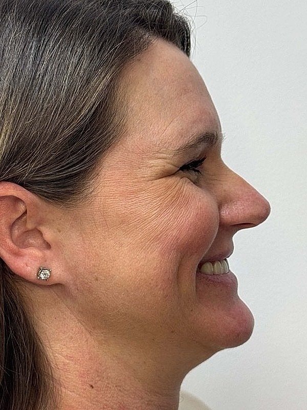 Botox Before & After