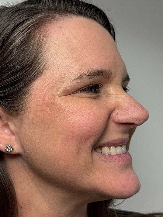 Botox Before & After