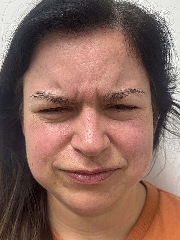 Botox Before & After