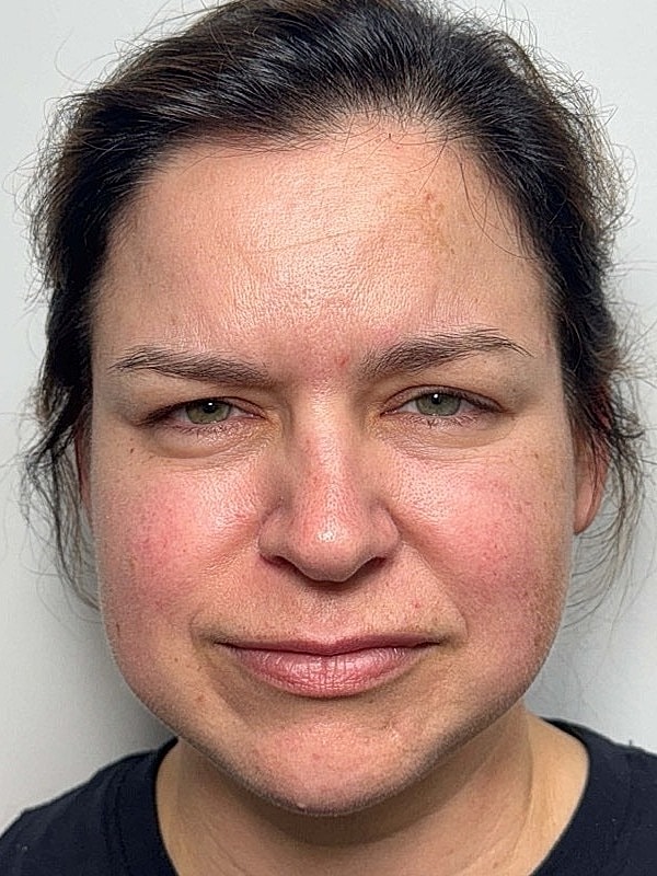 Botox Before & After