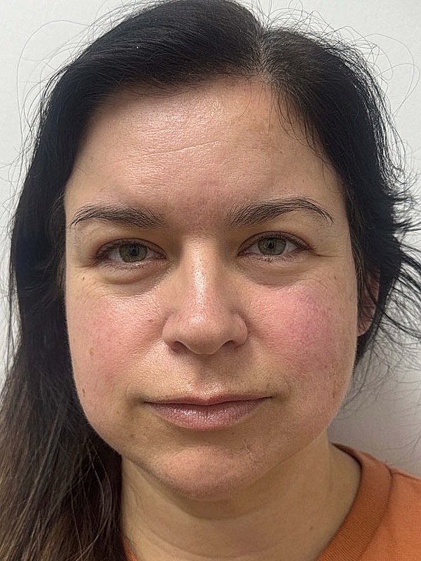 Botox Before & After