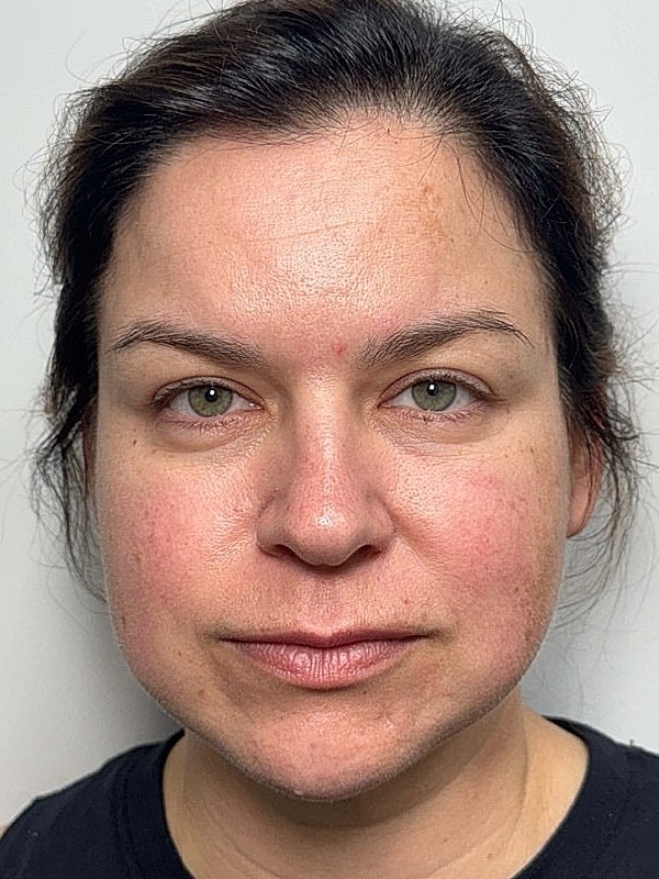 Botox Before & After