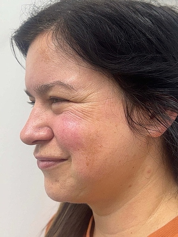 Botox Before & After