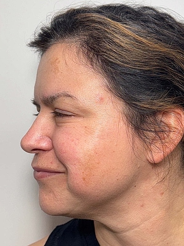 Botox Before & After