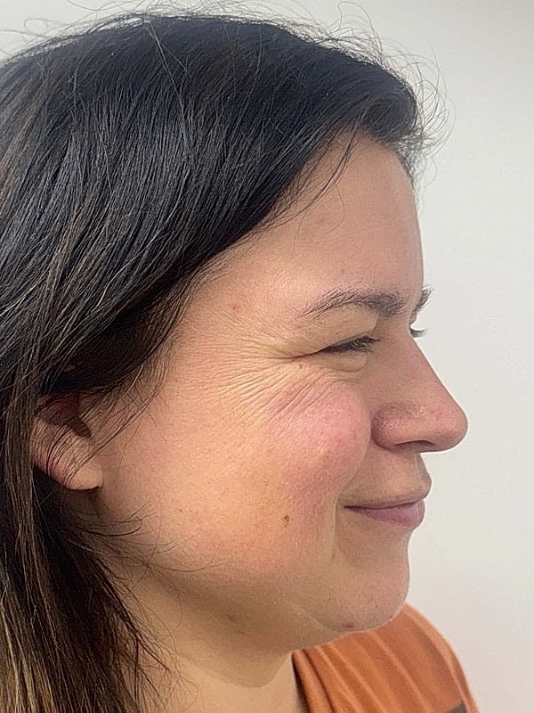 Botox Before & After