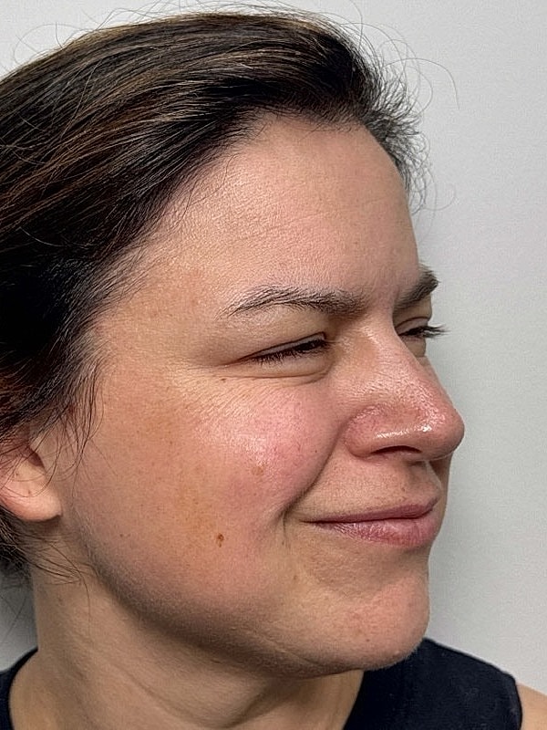 Botox Before & After