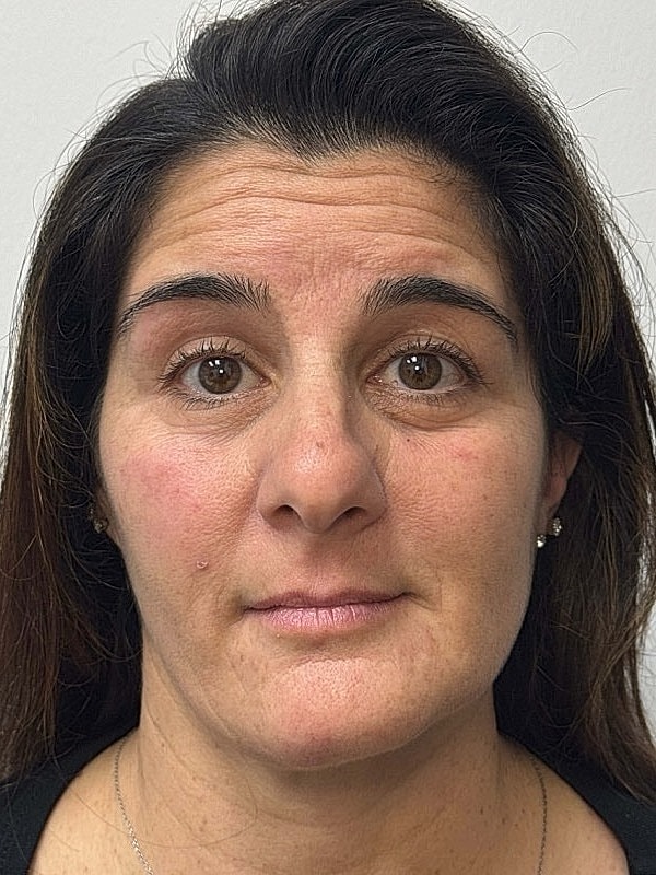 Botox Before & After