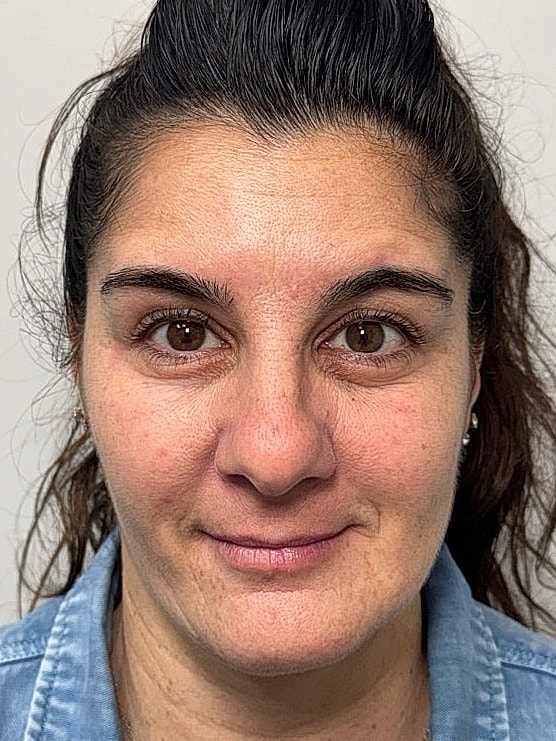 Botox Before & After