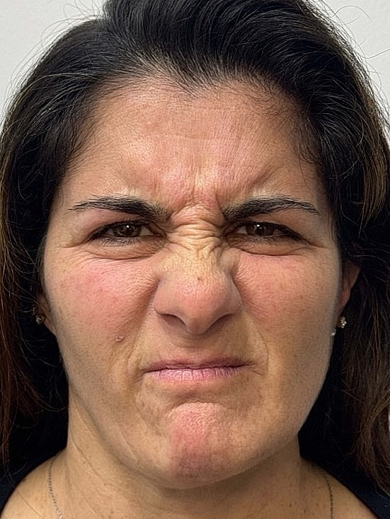Botox Before & After